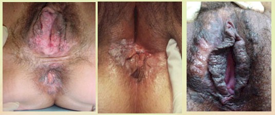 neoplasias_vulvovaginales_benignas/VIN_indiferenciado_bowenoide