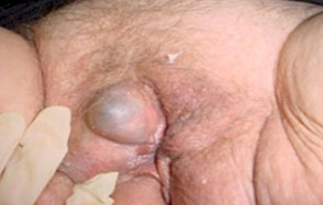 neoplasias_vulvovaginales_benignas/angiomas_vulvares_vaginales neoplasias_vulvovaginales_benignas/angiomas_vulvares_vaginales