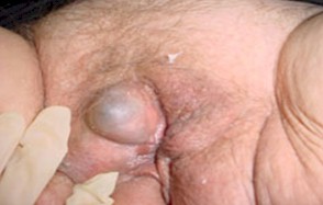 neoplasias_vulvovaginales_benignas/angiomas_vulvares_vaginales