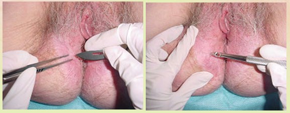 neoplasias_vulvovaginales_benignas/bisturi_punch_dermatologico