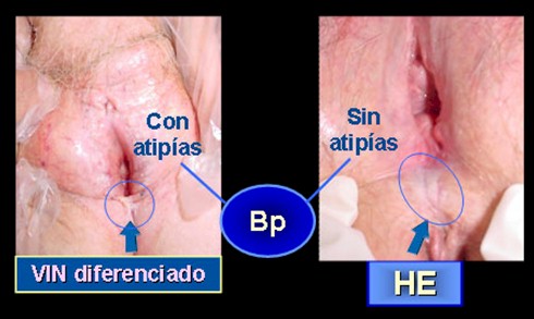 neoplasias_vulvovaginales_benignas/neoplasia_intraepitelial_vulva neoplasias_vulvovaginales_benignas/neoplasia_intraepitelial_vulva