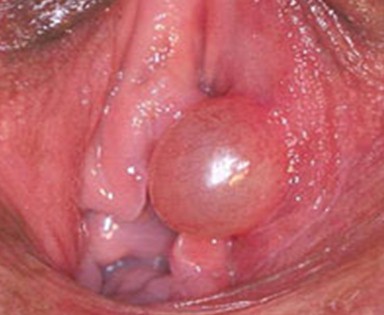 neoplasias_vulvovaginales_benignas/quiste_mucoso_vaginal