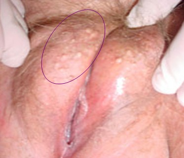 neoplasias_vulvovaginales_benignas/quiste_sebaceo_vagina