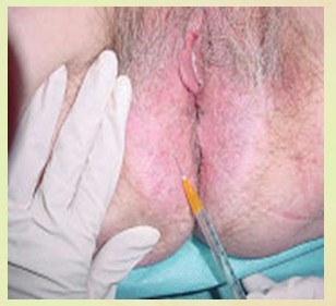 neoplasias_vulvovaginales_benignas/tecnica_biopsia_vaginal