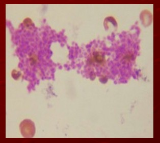 plaquetas_purpura_trombocitopenica/anatomia_patologica_microscopio