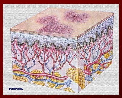 plaquetas_purpura_trombocitopenica/manchas_puntos_purpuricos