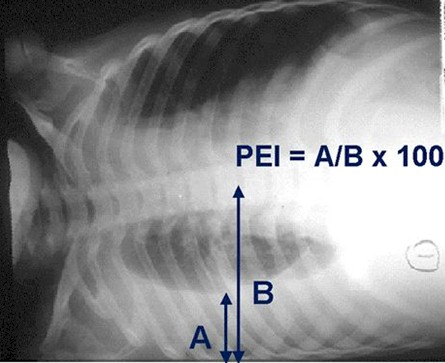 prevalencia_dengue_asintomatico/indice_efusion_pleural