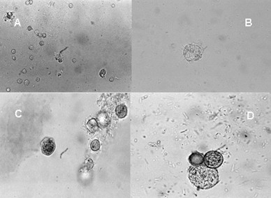 queratitis_cornea_acanthamoeba/bacilo_gramnegativo_quistes