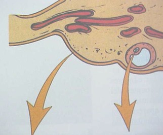 tumores_ovario_tumor/celulas_germinales_ovaricos