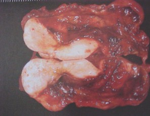tumores_ovario_tumor/cistoadenofibroma_cistadenofibroma tumores_ovario_tumor/cistoadenofibroma_cistadenofibroma