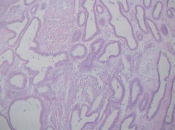 tumores_ovario_tumor/cistoadenofibroma_cistadenofibroma_histologia tumores_ovario_tumor/cistoadenofibroma_cistadenofibroma_histologia