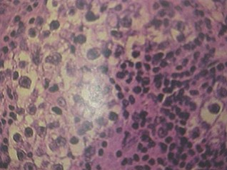tumores_ovario_tumor/disgerminoma_disgerminomas_histologia tumores_ovario_tumor/disgerminoma_disgerminomas_histologia