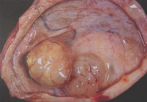 tumores_ovario_tumor/endometrioides_endometrioide_endometroide