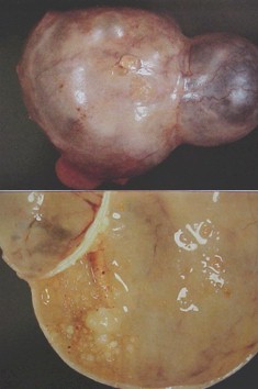 tumores_ovario_tumor/epitelio_superficial_celomicos