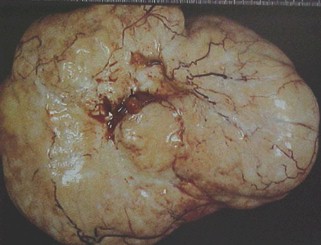 tumores_ovario_tumor/fibroma_fibromas_ovarico