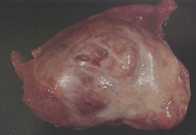 tumores_ovario_tumor/granulosa_teca_estrogenos