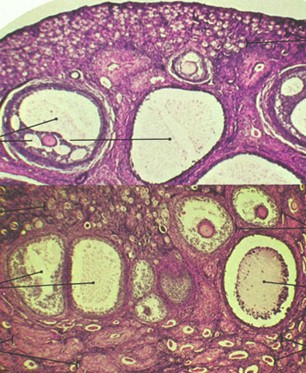 tumores_ovario_tumor/histologia_anatomia_patologica tumores_ovario_tumor/histologia_anatomia_patologica