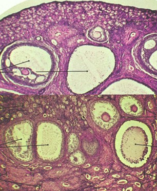 tumores_ovario_tumor/histologia_anatomia_patologica