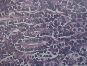 tumores_ovario_tumor/histologia_sertoli_leydig