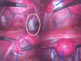 tumores_ovario_tumor/laparoscopia_vision_laparoscopica