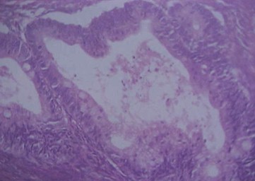 tumores_ovario_tumor/mucinosos_malignos_histologia