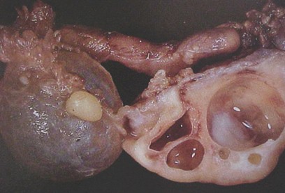 tumores_ovario_tumor/ovarios_poliquisticos_quisticos tumores_ovario_tumor/ovarios_poliquisticos_quisticos