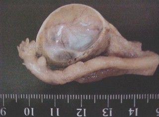 tumores_ovario_tumor/quiste_folicular_macroscopico tumores_ovario_tumor/quiste_folicular_macroscopico