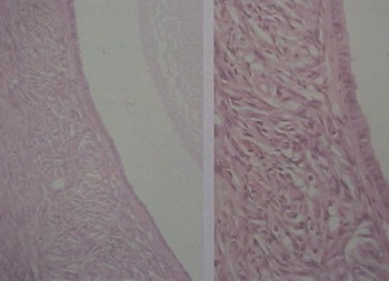 tumores_ovario_tumor/quiste_folicular_microscopico