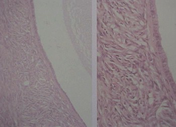 tumores_ovario_tumor/quiste_folicular_microscopico tumores_ovario_tumor/quiste_folicular_microscopico