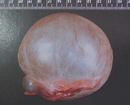 tumores_ovario_tumor/quiste_luteinico tumores_ovario_tumor/quiste_luteinico