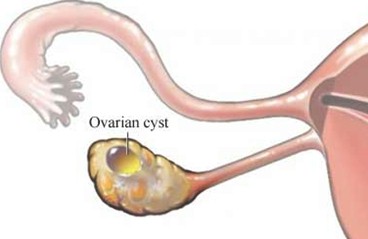 tumores_ovario_tumor/quiste_ovarico