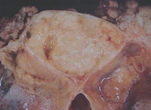 tumores_ovario_tumor/seroso_malignos_maligno