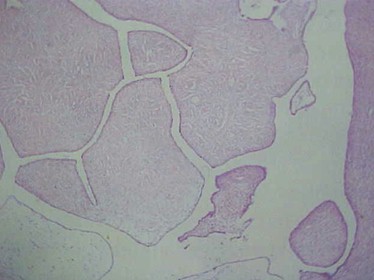 tumores_ovario_tumor/serosos_histologia_microscopia
