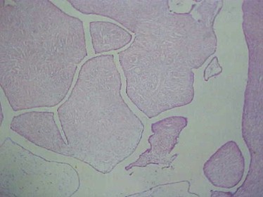 tumores_ovario_tumor/serosos_histologia_microscopia tumores_ovario_tumor/serosos_histologia_microscopia