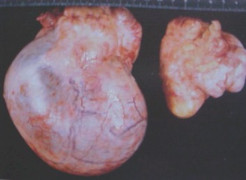 tumores_ovario_tumor/serosos_malignos_maligno