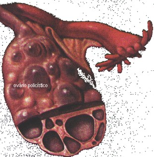 tumores_ovario_tumor/sindrome_ovario_poliquistico tumores_ovario_tumor/sindrome_ovario_poliquistico