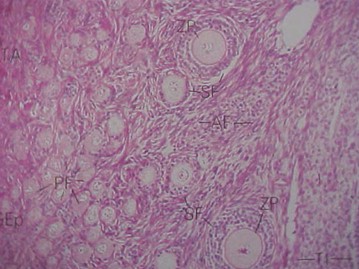tumores_ovario_tumor/tejido_ovarico_microscopio tumores_ovario_tumor/tejido_ovarico_microscopio