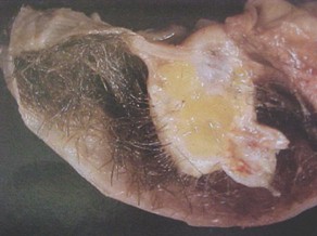 tumores_ovario_tumor/teratoma_maduro_benigno tumores_ovario_tumor/teratoma_maduro_benigno