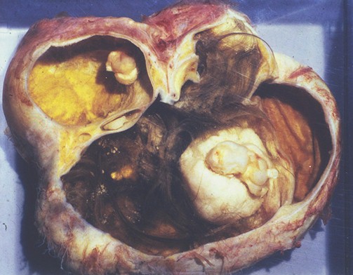 tumores_ovario_tumor/teratoma_teratomas_ovarico