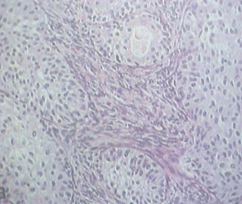 tumores_ovario_tumor/tumor_Brenner_histologia tumores_ovario_tumor/tumor_Brenner_histologia