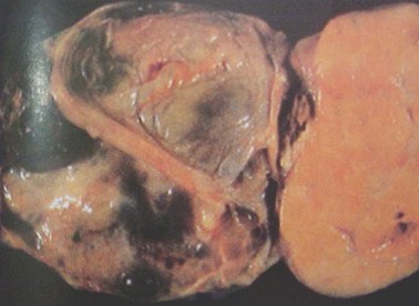 tumores_ovario_tumor/tumor_Brenner_macroscopico tumores_ovario_tumor/tumor_Brenner_macroscopico