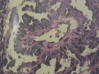 tumores_ovario_tumor/tumor_seno_endodermico tumores_ovario_tumor/tumor_seno_endodermico