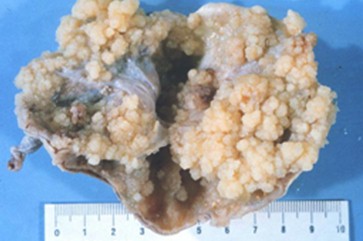 tumores_ovario_tumor/tumores_limitrofes tumores_ovario_tumor/tumores_limitrofes
