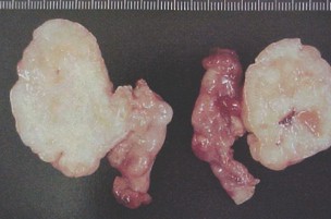 tumores_ovario_tumor/tumores_metastasicos