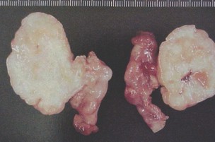 tumores_ovario_tumor/tumores_metastasicos tumores_ovario_tumor/tumores_metastasicos