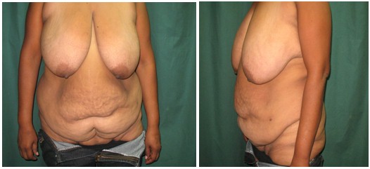 cirugia_obesidad_morbida/preoperatorio_dermolipectomia_abdominal