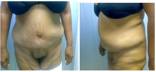 cirugia_obesidad_morbida/resultados_dermolipectomia_abdominal