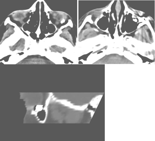 cuerpo_traumatismo_intraorbitario/TAC_orbita_ocular