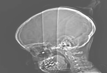 cuerpo_traumatismo_intraorbitario/radiografia_orbita_ocular cuerpo_traumatismo_intraorbitario/radiografia_orbita_ocular