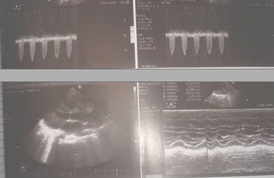 desgarro_arteria_femoral/ecocardiograma_valvula_aortica